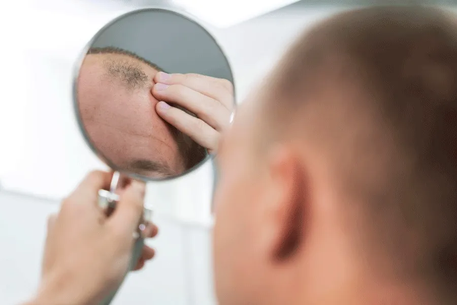 8 consigli per prevenire il gonfiore dopo il trapianto di capelli