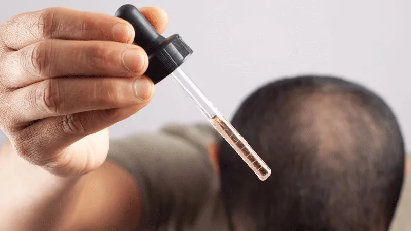 È necessario assumere il Minoxidil dopo il trapianto di capelli?