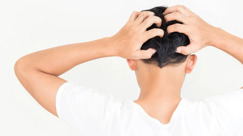 Quali sono le cause del prurito dopo il trapianto di capelli?
